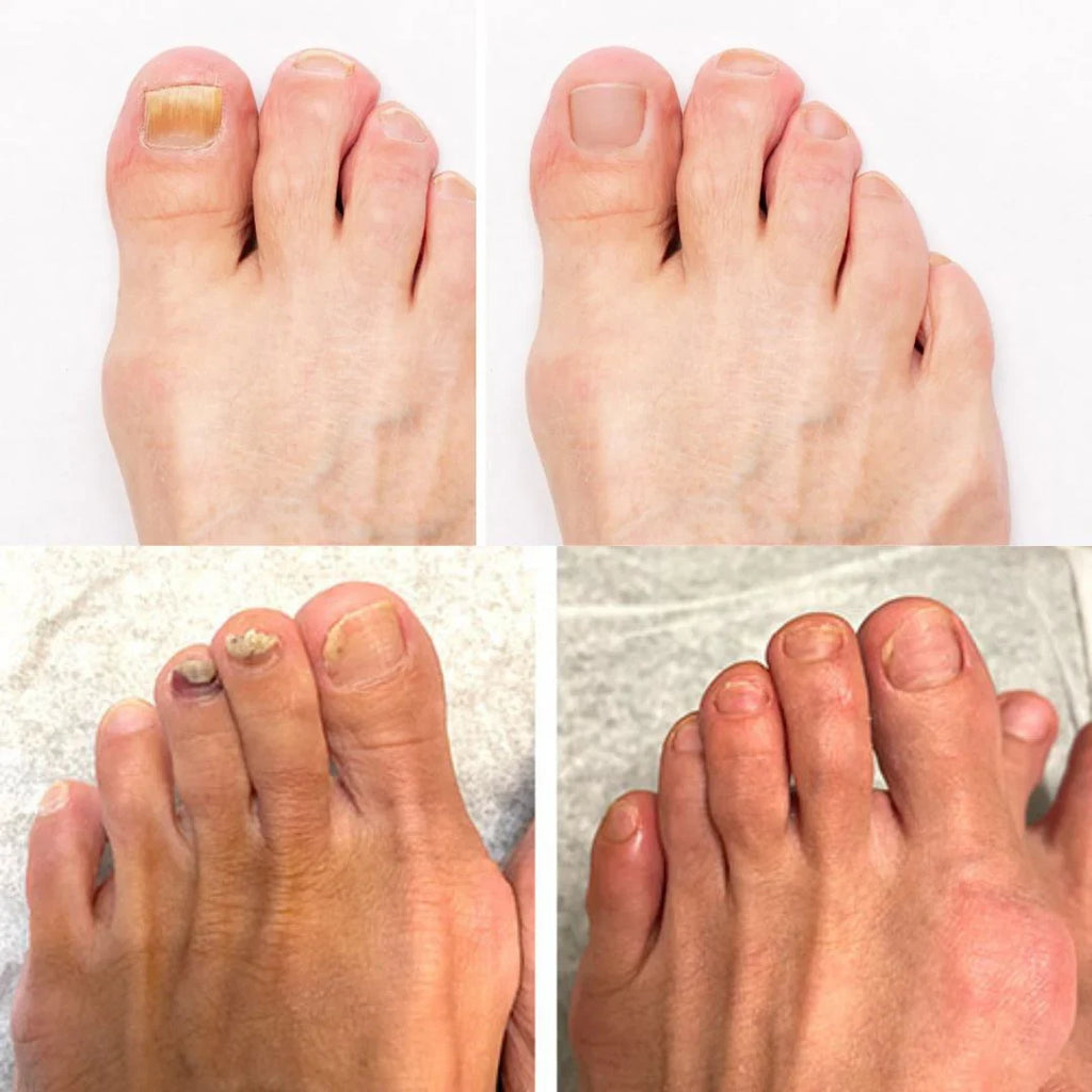 PureNail - Terapia patentada contra hongos en las uñas – para uñas sanas en 4 semanas