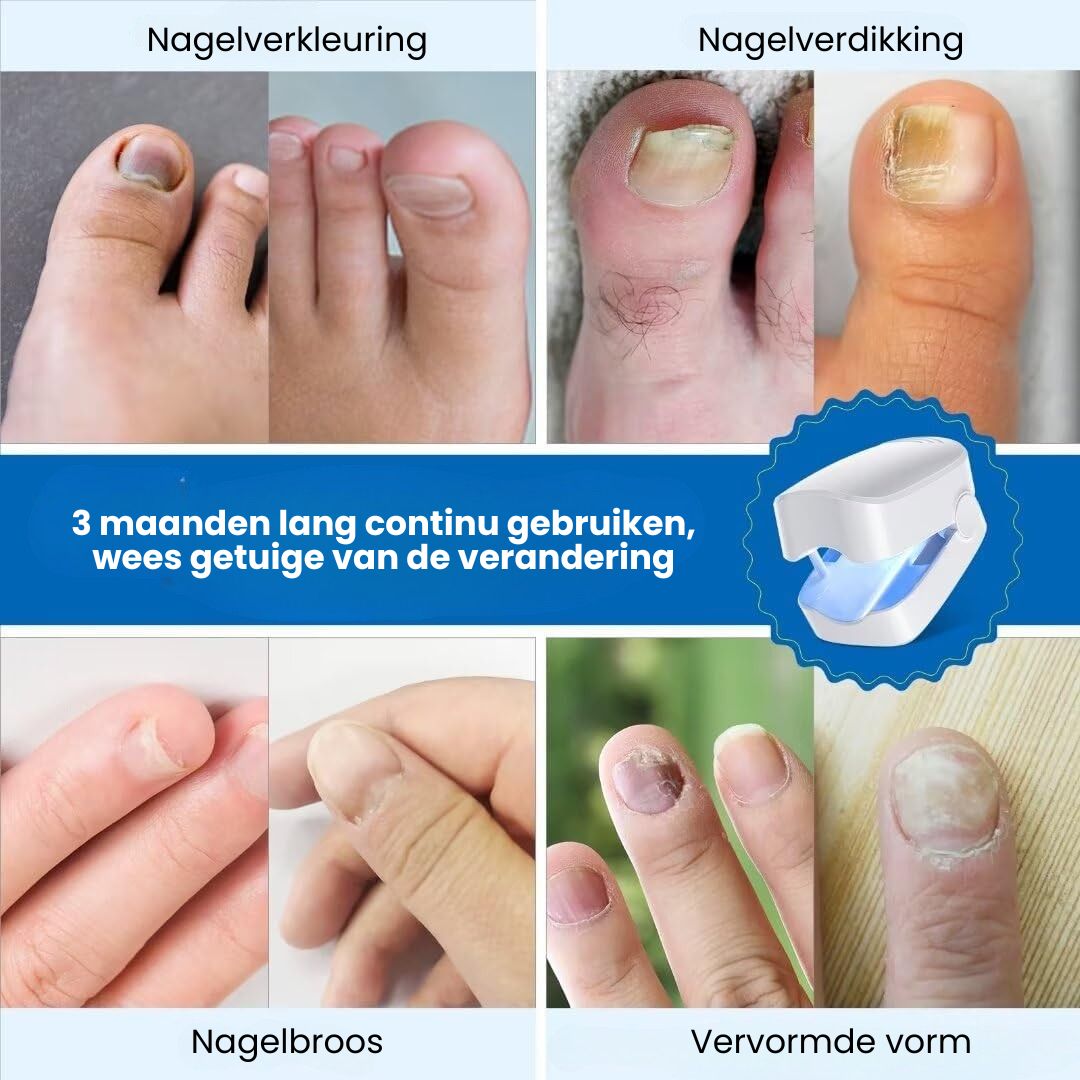 DermaNail - Traitement breveté contre les mycoses des ongles – pour des ongles sains en 4 semaines