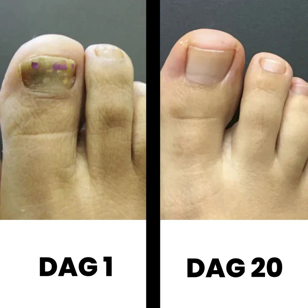 PureNail - Terapia patentada contra hongos en las uñas – para uñas sanas en 4 semanas