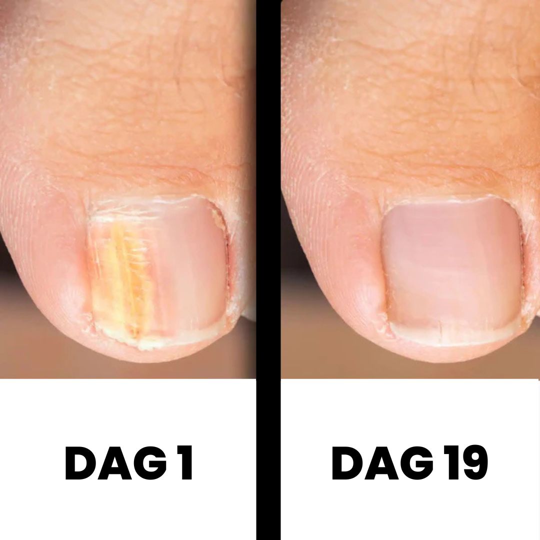 PureNail - Terapia patentada contra hongos en las uñas – para uñas sanas en 4 semanas