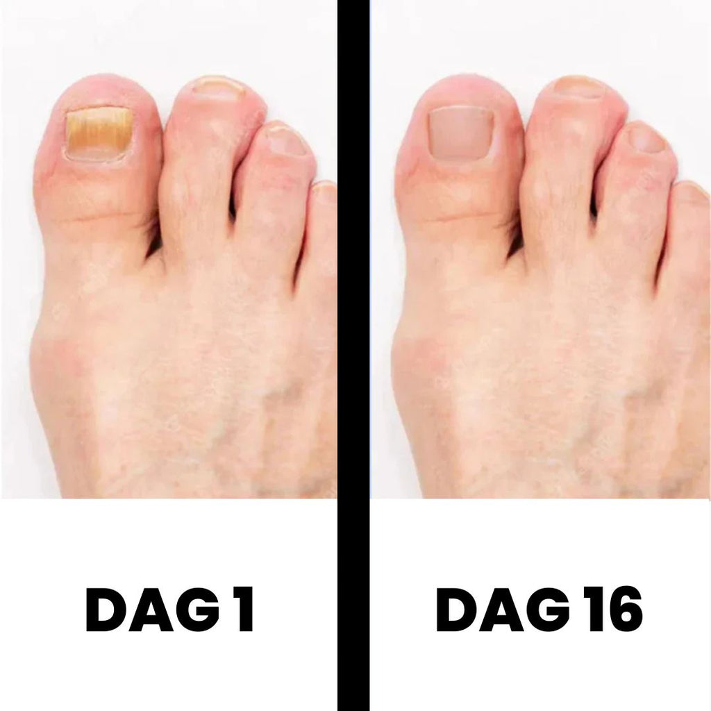 DermaNail - Traitement breveté contre les mycoses des ongles – pour des ongles sains en 4 semaines