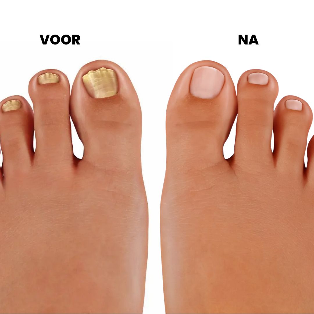 PureNail - Terapia patentada contra hongos en las uñas – para uñas sanas en 4 semanas